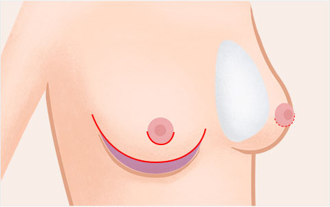 하수교정